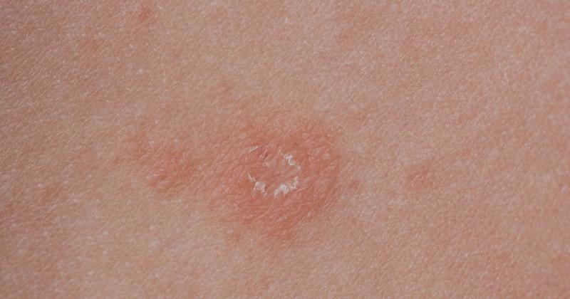 Czy liszaj jest zaraźliwy