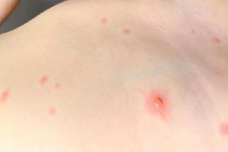 Komplikacje zdrowotne po ospie wietrznej