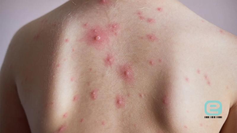 Objawy i przebieg ospy wietrznej