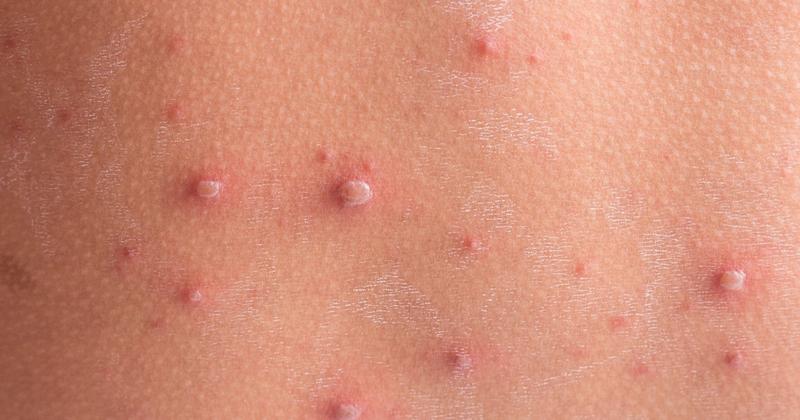 Ospa wietrzna u nieszczepionych dzieci