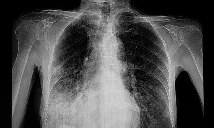 Profilaktyka zapalenia płuc