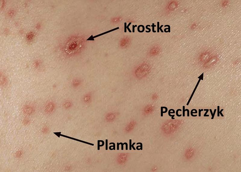 Znaczenie szczepień przeciw ospie wietrznej