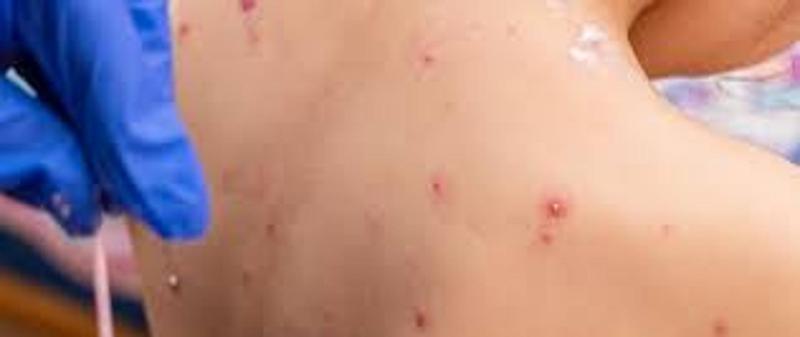 Jak przebiega ospa u dzieci nieszczepionych i co warto o tym wiedzieć?