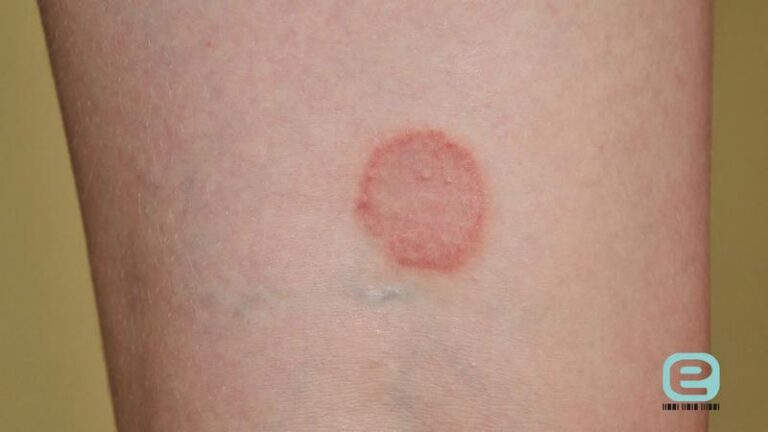 Liszaj u dziecka – czy grozi nam zarażenie?