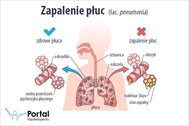 Skuteczne metody leczenia zapalenia płuc u dzieci – co warto wiedzieć?