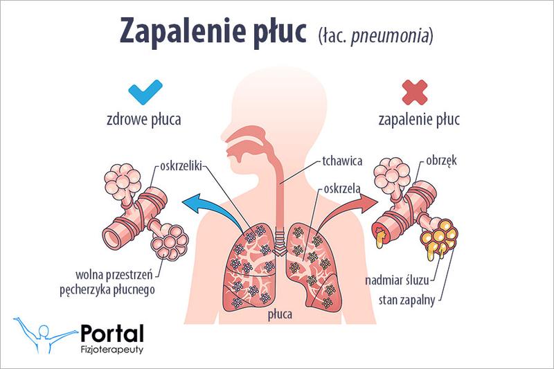 Skuteczne metody leczenia zapalenia płuc u dzieci – co warto wiedzieć?
