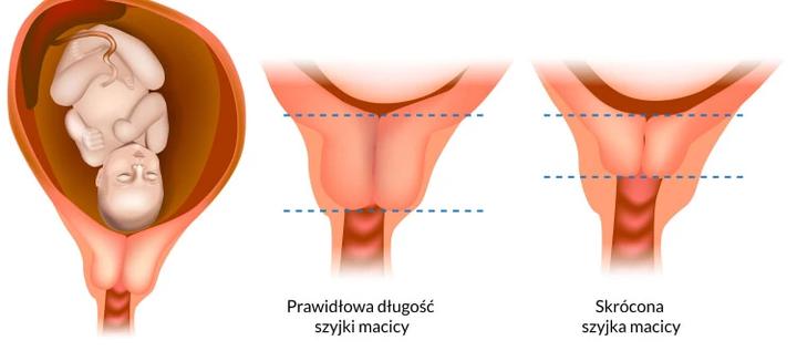 Długość szyjki macicy w ciąży