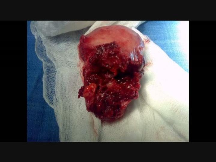 Przyczyny i diagnoza poronienia