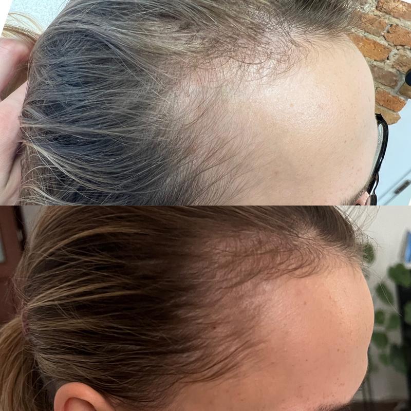 Suplementy diety na wypadanie włosów