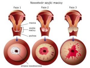 Co oznacza zły wynik cytologii po porodzie dla twojego zdrowia?