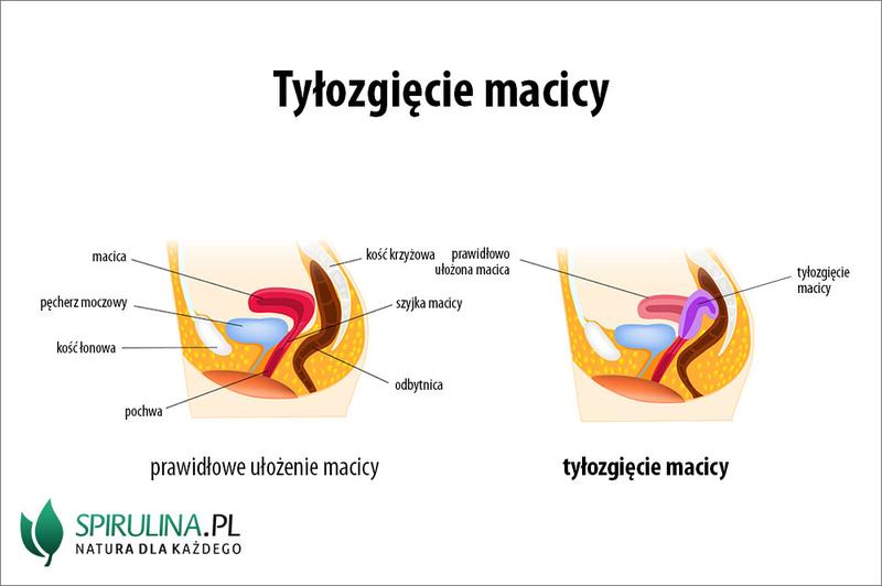 Czy tyłozgięcie macicy może być przeszkodą w zajściu w ciążę?