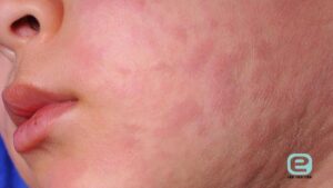 Objawy uczulenia na gluten u niemowląt karmionych piersią – jak je rozpoznać?