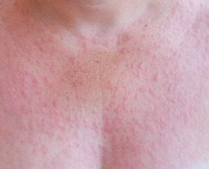 Uczulenie na słońce u dzieci - jak je rozpoznać i co robić?