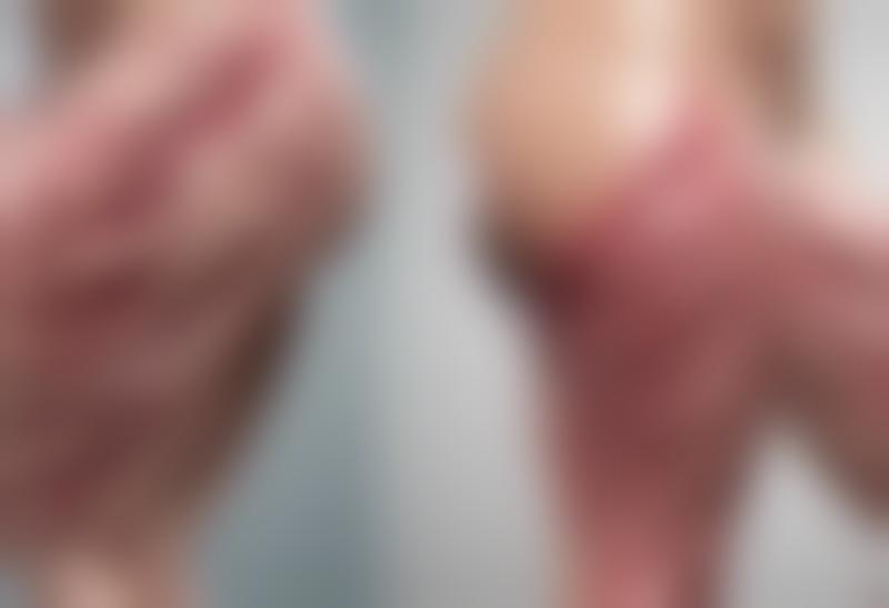 Metody leczenia żylaków