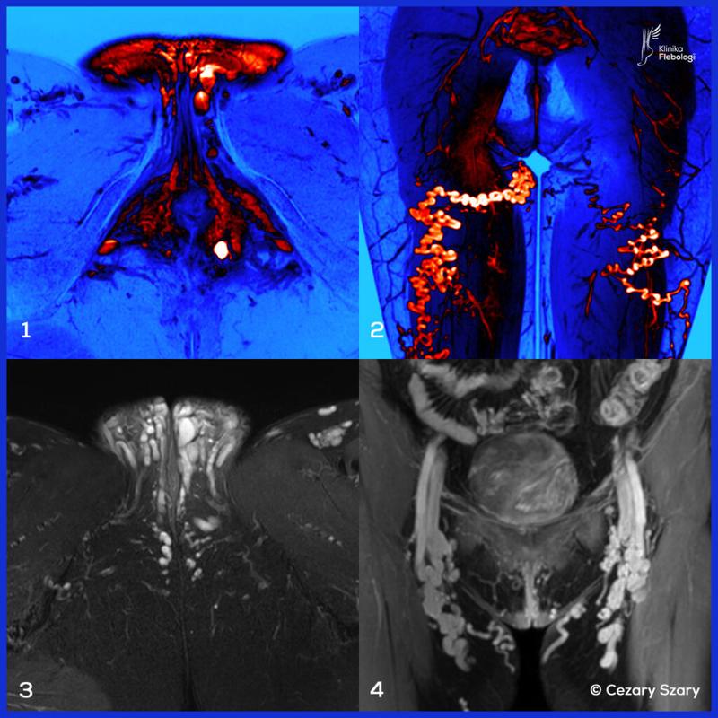 Objawy żylaków sromu