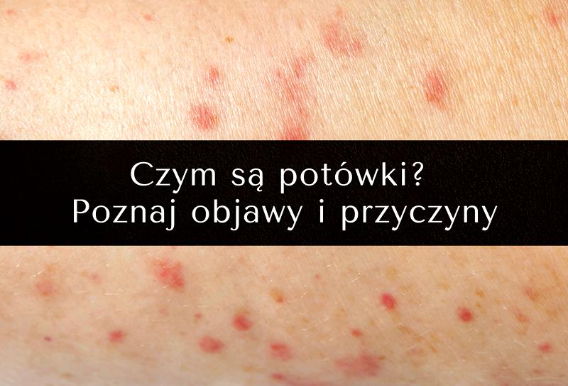 Potówki u dzieci