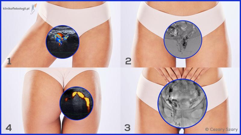 Żylaki sromu po porodzie