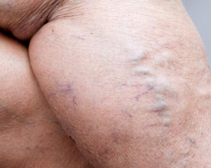 Jak radzić sobie z żylakami sromu po porodzie? Praktyczne porady dla mam