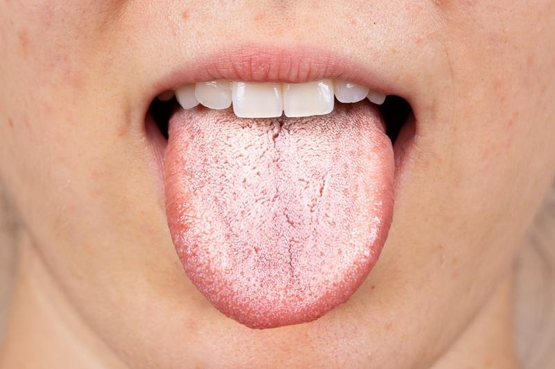Jak radzić sobie z kandydozą podczas karmienia piersią?